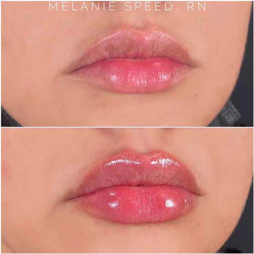 Lip Augmentation Before & After Photos by Flawless Medspa in Las Vegas NV