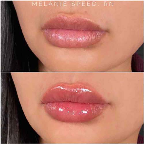 Lip Augmentation Before & After Photos by Flawless Medspa in Las Vegas NV