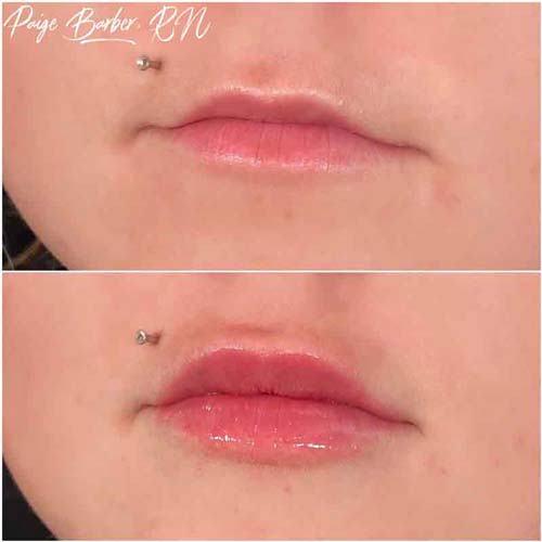 Lip Augmentation Before & After Photos by Flawless Medspa in Las Vegas NV