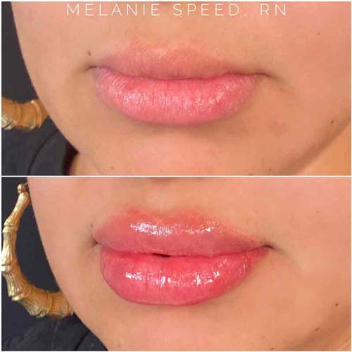 Lip Augmentation Before & After Photos by Flawless Medspa in Las Vegas NV