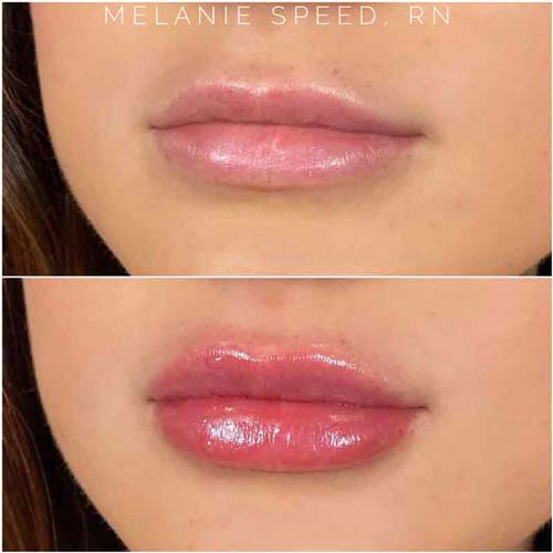 Lip Augmentation Before & After Photos by Flawless Medspa in Las Vegas NV