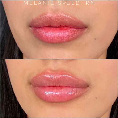 Lip Augmentation Before & After Photos by Flawless Medspa in Las Vegas NV