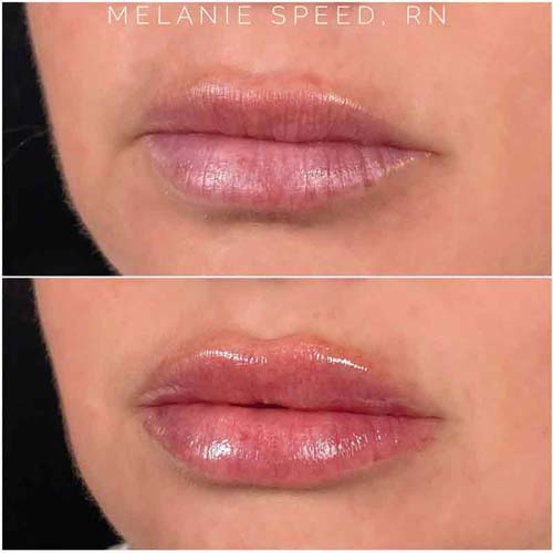 Lip Augmentation Before & After Photos by Flawless Medspa in Las Vegas NV