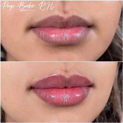 Lip Augmentation Before & After Photos by Flawless Medspa in Las Vegas NV