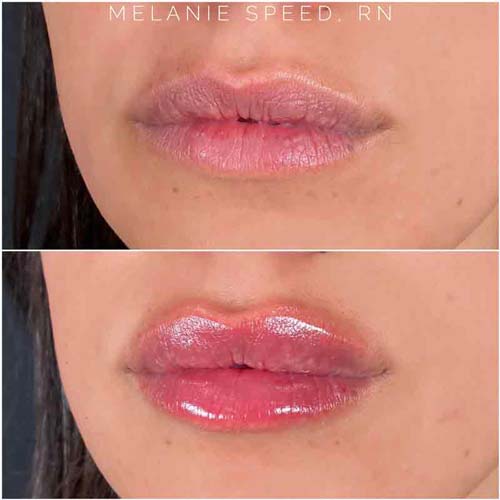 Lip Augmentation Before & After Photos by Flawless Medspa in Las Vegas NV