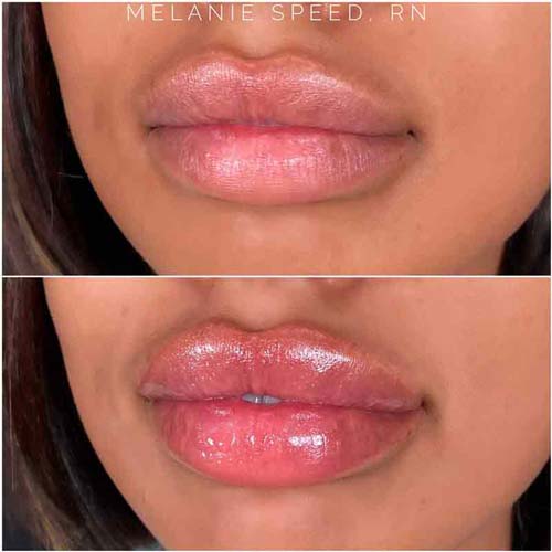 Lip Augmentation Before & After Photos by Flawless Medspa in Las Vegas NV