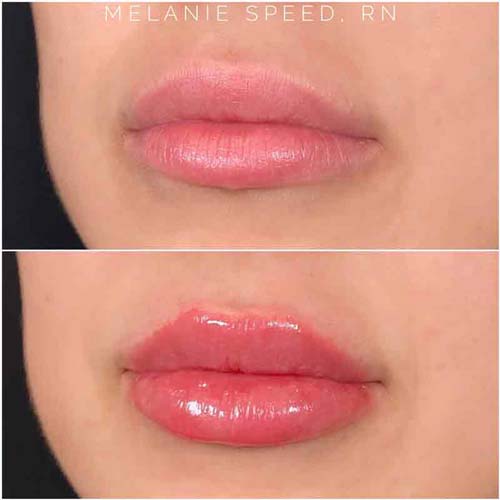 Lip Augmentation Before & After Photos by Flawless Medspa in Las Vegas NV