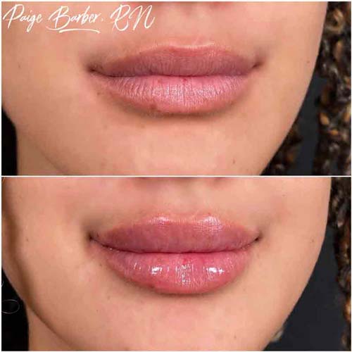 Lip Augmentation Before & After Photos by Flawless Medspa in Las Vegas NV