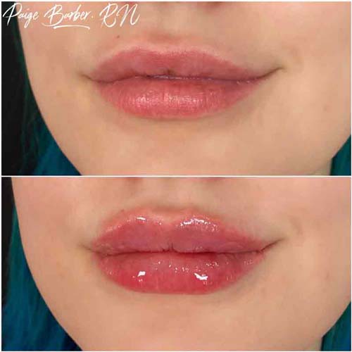 Lip Augmentation Before & After Photos by Flawless Medspa in Las Vegas NV