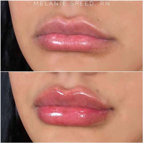 Lip Augmentation Before & After Photos by Flawless Medspa in Las Vegas NV