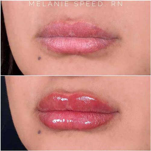 Lip Augmentation Before & After Photos by Flawless Medspa in Las Vegas NV