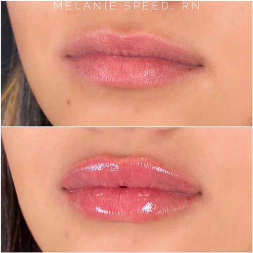 Lip Augmentation Before & After Photos by Flawless Medspa in Las Vegas NV