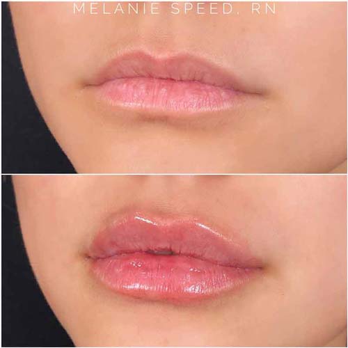 Lip Augmentation Before & After Photos by Flawless Medspa in Las Vegas NV