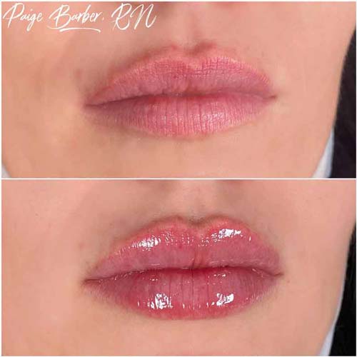 Lip Augmentation Before & After Photos by Flawless Medspa in Las Vegas NV