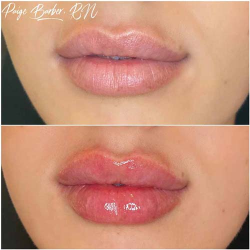 Lip Augmentation Before & After Photos by Flawless Medspa in Las Vegas NV