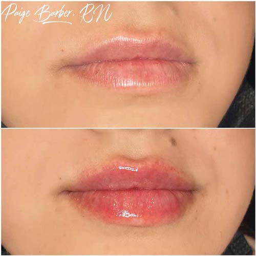 Lip Augmentation Before & After Photos by Flawless Medspa in Las Vegas NV