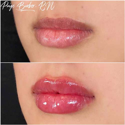 Lip Augmentation Before & After Photos by Flawless Medspa in Las Vegas NV