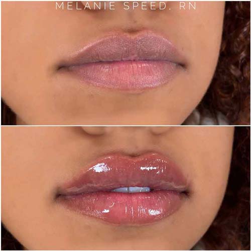 Lip Augmentation Before & After Photos by Flawless Medspa in Las Vegas NV