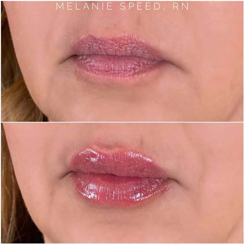 Lip Augmentation Before & After Photos by Flawless Medspa in Las Vegas NV