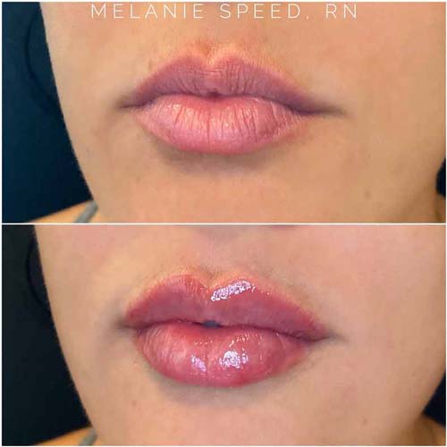 Lip Augmentation Before & After Photos by Flawless Medspa in Las Vegas NV