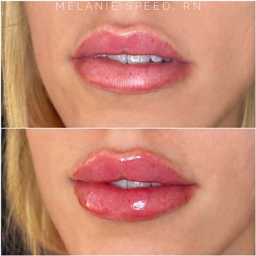 Lip Augmentation Before & After Photos by Flawless Medspa in Las Vegas NV