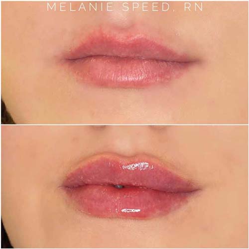 Lip Augmentation Before & After Photos by Flawless MedSpa & The Beverly Hills MedSpa in Las Vegas NV Lip Augmentation Before & After Photos by Flawless MedSpa & The Beverly Hills MedSpa in Las Vegas NV