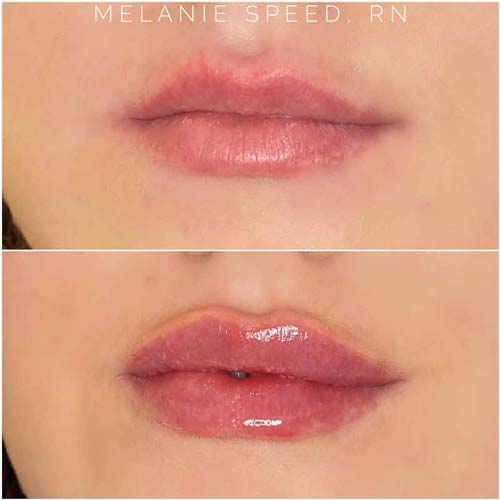 Lip Augmentation Before & After Photos by Flawless Medspa in Las Vegas NV