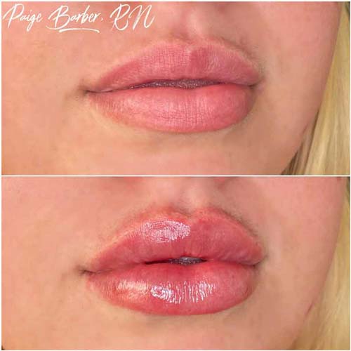 Lip Augmentation Before & After Photos by Flawless Medspa in Las Vegas NV