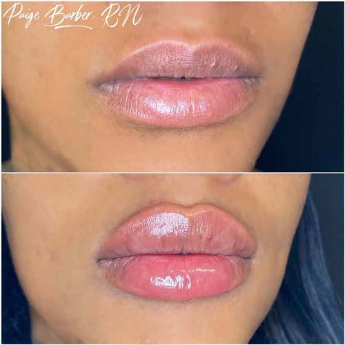 Lip Augmentation Before & After Photos by Flawless Medspa in Las Vegas NV