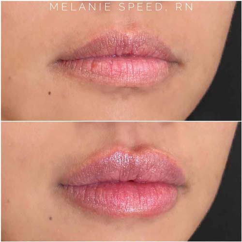 Lip Augmentation Before & After Photos by Flawless Medspa in Las Vegas NV