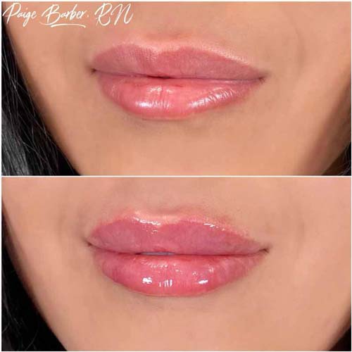 Lip Augmentation Before & After Photos by Flawless Medspa in Las Vegas NV