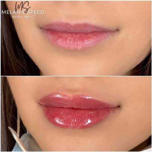 Lip Augmentation Before & After Photos by Flawless Medspa in Las Vegas NV