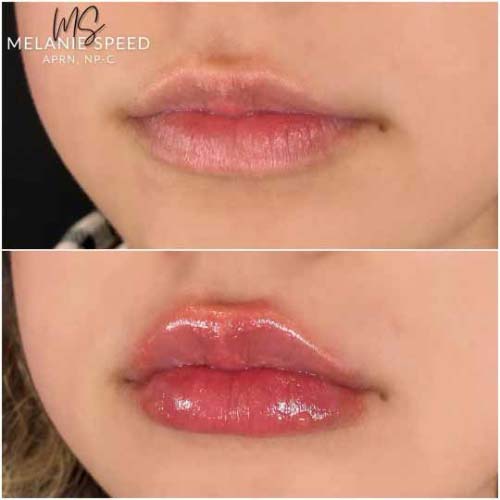 Lip Augmentation Before & After Photos by Flawless Medspa in Las Vegas NV