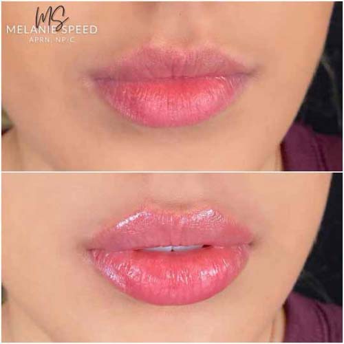 Lip Augmentation Before & After Photos by Flawless Medspa in Las Vegas NV