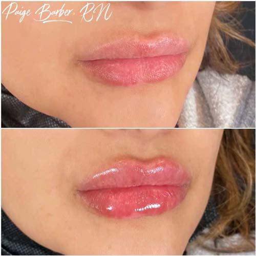 Lip Augmentation Before & After Photos by Flawless Medspa in Las Vegas NV