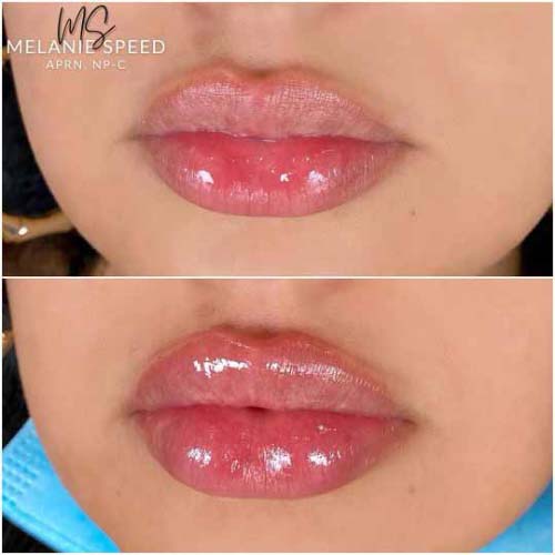 Lip Augmentation Before & After Photos by Flawless Medspa in Las Vegas NV