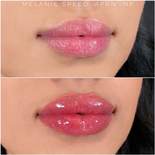 Lip Augmentation Before & After Photos by Flawless MedSpa & The Beverly Hills MedSpa in Las Vegas NV Lip Augmentation Before & After Photos by Flawless MedSpa & The Beverly Hills MedSpa in Las Vegas NV