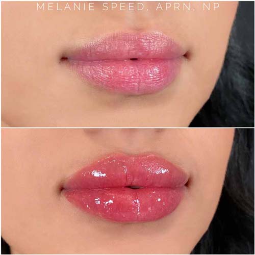 Lip Augmentation Before & After Photos by Flawless Medspa in Las Vegas NV