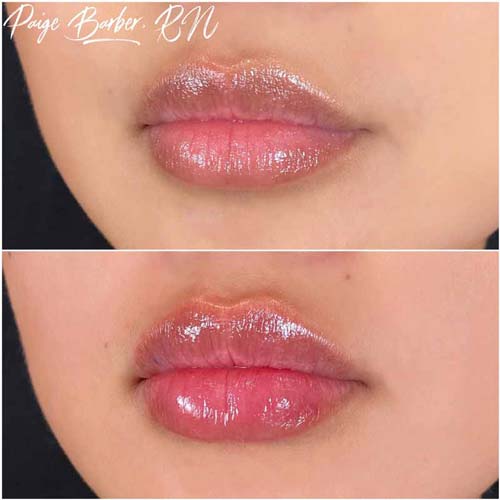 Lip Augmentation Before & After Photos by Flawless Medspa in Las Vegas NV