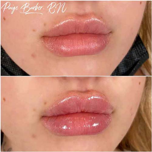 Lip Augmentation Before & After Photos by Flawless Medspa in Las Vegas NV