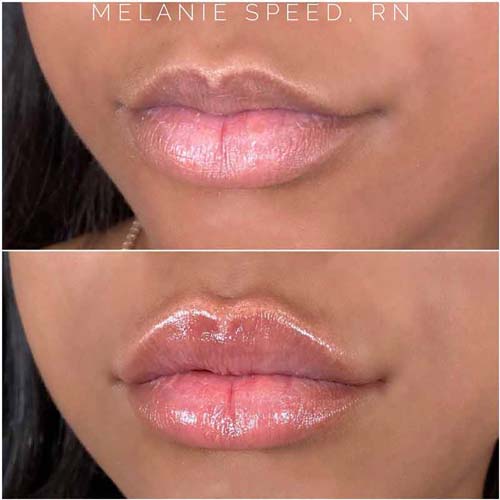 Lip Augmentation Before & After Photos by Flawless Medspa in Las Vegas NV