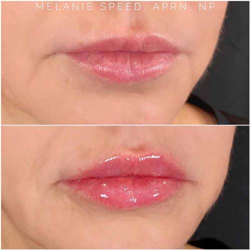 Lip Augmentation Before & After Photos by Flawless Medspa in Las Vegas NV