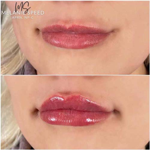 Lip Augmentation Before & After Photos by Flawless Medspa in Las Vegas NV