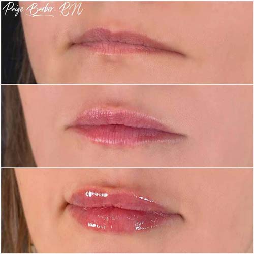 Lip Augmentation Before & After Photos by Flawless Medspa in Las Vegas NV