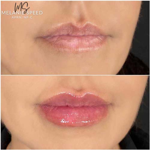 Lip Augmentation Before & After Photos by Flawless Medspa in Las Vegas NV