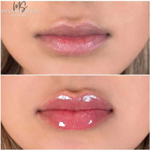 Lip Augmentation Before & After Photos by Flawless Medspa in Las Vegas NV