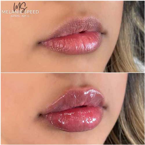 Lip Augmentation Before & After Photos by Flawless Medspa in Las Vegas NV