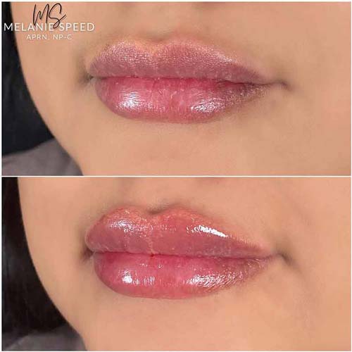 Lip Augmentation Before & After Photos by Flawless Medspa in Las Vegas NV