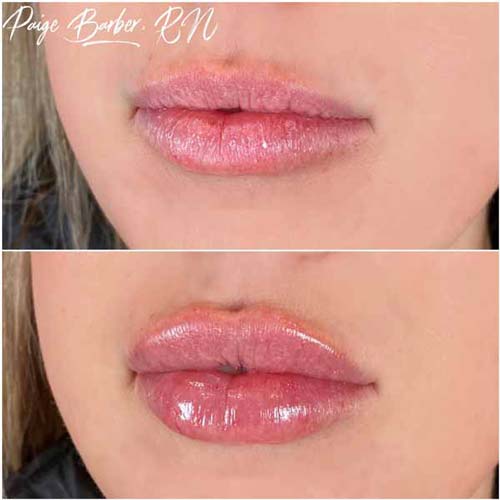 Lip Augmentation Before & After Photos by Flawless Medspa in Las Vegas NV