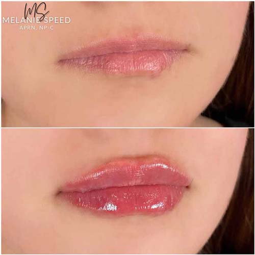 Lip Augmentation Before & After Photos by Flawless Medspa in Las Vegas NV